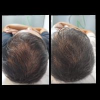 Tratamiento facial y capilar mediante exosomas en Retiro