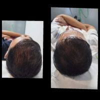 Tratamiento facial y capilar mediante exosomas en Retiro