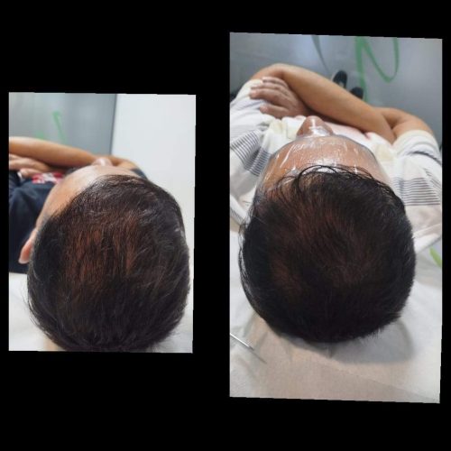 Tratamiento facial y capilar mediante exosomas en Retiro